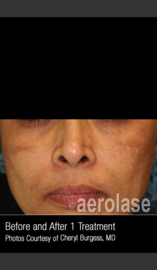Before Photo for Treatment of Melasma #318 -  - Prejuvenation