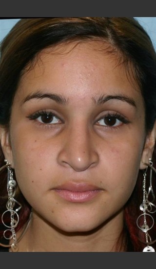 Before Photo for Rhinoplasty - Case 16 - Konstantin Vasyukevich, MD - Prejuvenation
