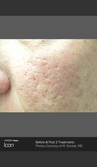 Before Photo for Acne Scaring on the Cheeks -  - Prejuvenation