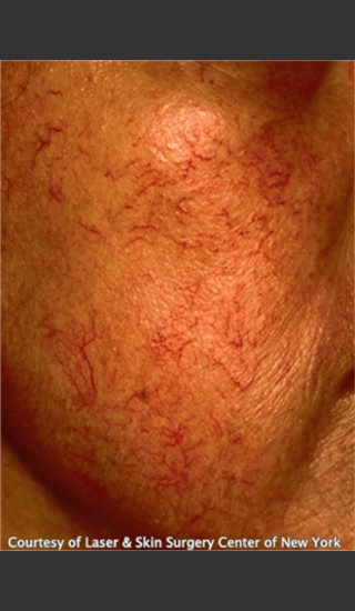 Before Photo for Treatment of Facial Redness -  - Prejuvenation