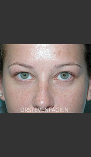 After Photo for Lower Eyelid Fat Removal - Patient 4 - Steven Fagien, MD - Prejuvenation