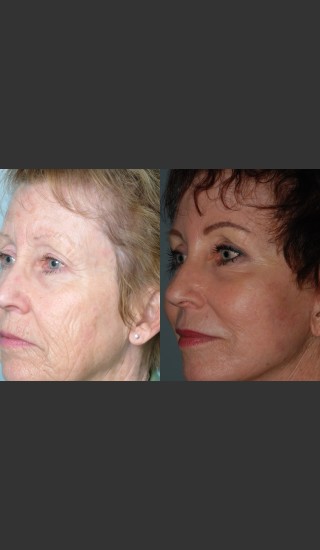 After Photo for Full Face Rejuvenation - Mark B. Taylor, M.D. - Prejuvenation