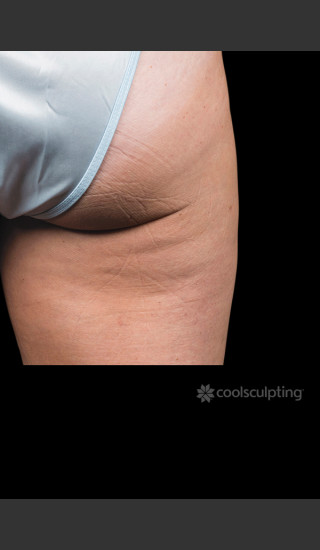 After Photo for CoolSculpting Before & After on Woman -  - Prejuvenation
