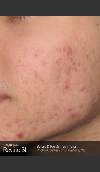 Before Photo for Revlite SI Treatment of Facial  Acne Scarring -  - Prejuvenation