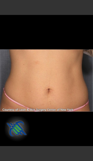 After Photo for Treatment of Lower Abdomen with CoolSculpting - Roy G. Geronemus, M.D. - Prejuvenation