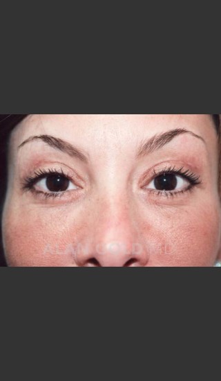 After Photo for Blepharoplasty 871 - Alan Gold MD - Prejuvenation