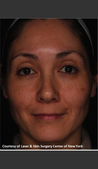 After Photo for Facial Skin Rejuvenation with Clear and Brillant Permea - Roy G. Geronemus, M.D. - Prejuvenation