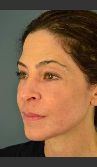 After Photo for C02 & Thermage Treatment #47 - Dr. David Amron - Prejuvenation