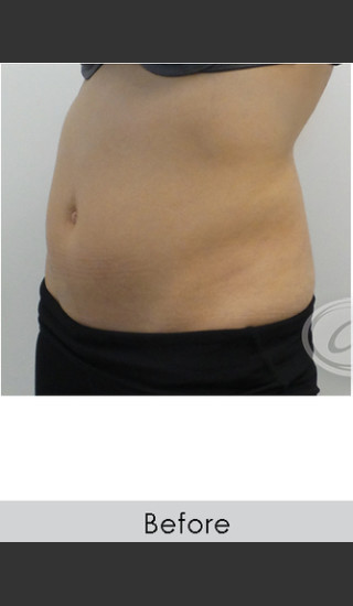 Before Photo for CoolSculpting+ Abdomen Treatment - Annie Chiu, MD - Prejuvenation