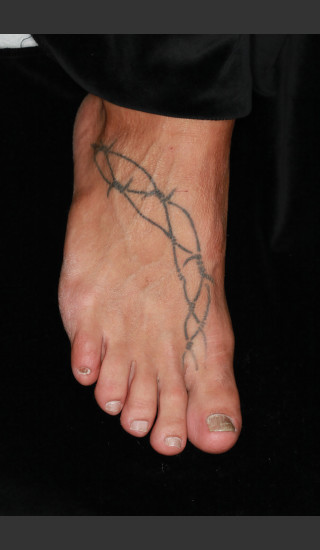 Before Photo for Quanta Q-Plus C Laser Tattoo Removal #72 -  - Prejuvenation