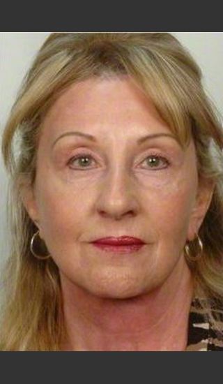After Photo for 61 year old woman treated with Facelift - R. Scott Yarish MD, FACS - Prejuvenation