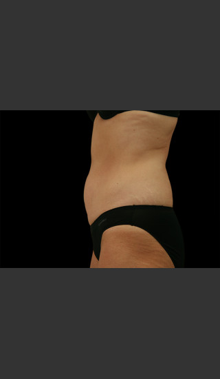 After Photo for Body Contouring Treatment #110 -  - Prejuvenation