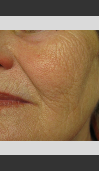 After Photo for Profound Smooth Treatment: Volumize Cheeks -  - Prejuvenation