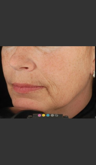 Before Photo for Botox Dermal Fillers and Pigment Removal  - Brian D. Zelickson, M.D. - Prejuvenation