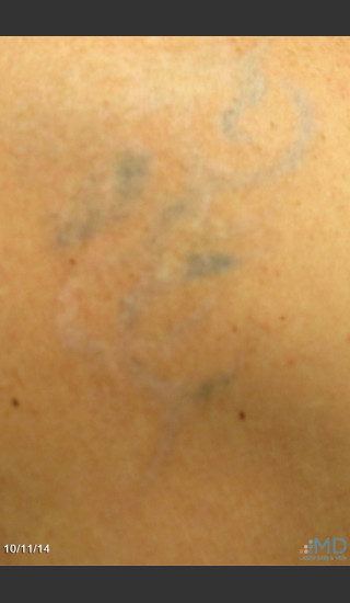 After Photo for Picosure Laser Tattoo Removal of Lion - Margaret Ann Weiss - Prejuvenation