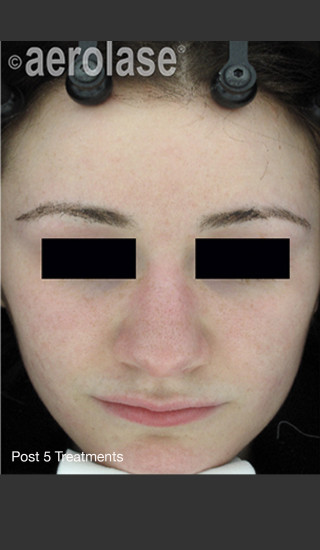 After Photo for NeoClear by Aerolase Acne Treatment - David J. Goldberg, M.D. - Prejuvenation