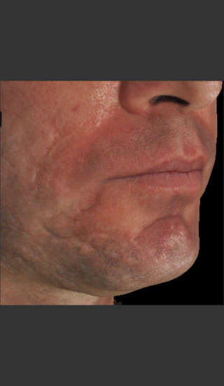 Before Photo for Infini Acne Scar Treatment #13 -  - Prejuvenation