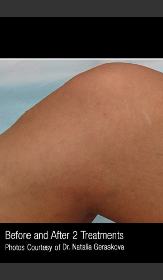 After Photo for Treatment of Leg Veins #316 -  - Prejuvenation