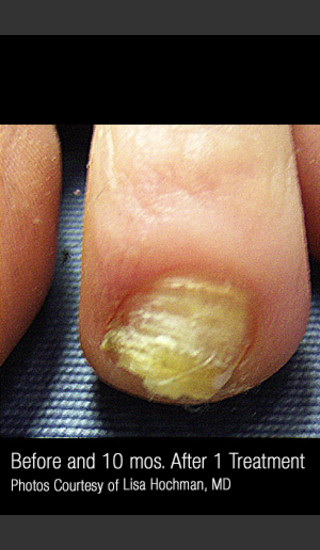 Before Photo for Treatment of Nail Fungus #320 -  - Prejuvenation