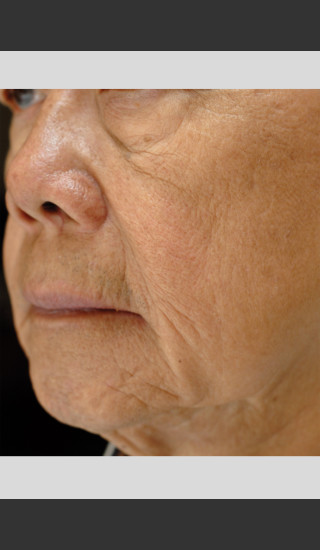 Before Photo for elos Motif IR for Focused Wrinkle Treatment -  - Prejuvenation