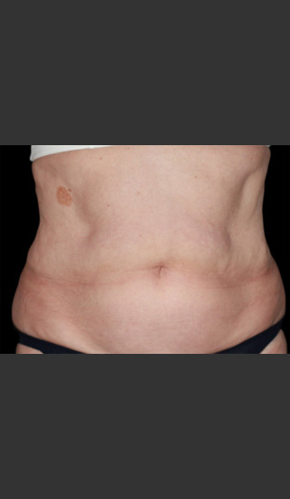 After Photo for Body Contouring Treatment #112 -  - Prejuvenation