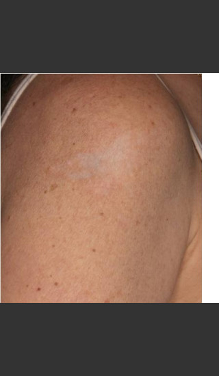 After Photo for Treatment of Shoulder Tattoo - Roy G. Geronemus, M.D. - Prejuvenation