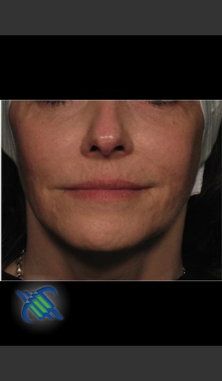 After Photo for Facial Laxity of Lower Face with Profound - Roy G. Geronemus, M.D. - Prejuvenation