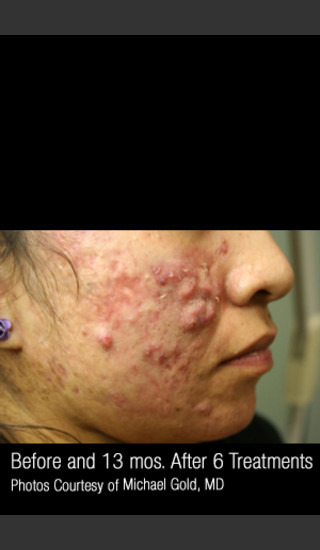 Before Photo for Treatment of Cystic Acne #302 -  - Prejuvenation