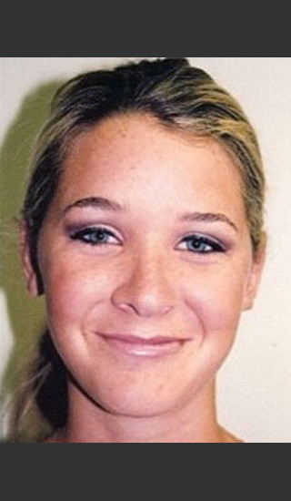 After Photo for Otoplasty Case 7085 - Sanjay Grover MD FACS - Prejuvenation