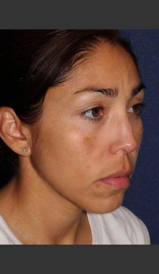 Before Photo for Facial Pigmentation Removal - Dr. Sabrina G. Fabi - Prejuvenation