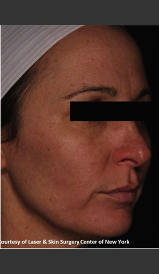 After Photo for Full face Treament with Fraxel - Roy G. Geronemus, M.D. - Prejuvenation