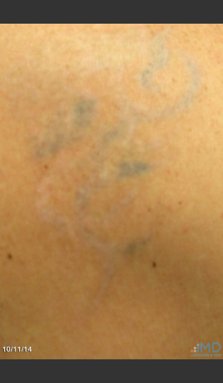 After Photo for Picosure Laser Tattoo Removal - Robert Weiss, M.D., F.A.A.D., F.A.C.Ph - Prejuvenation