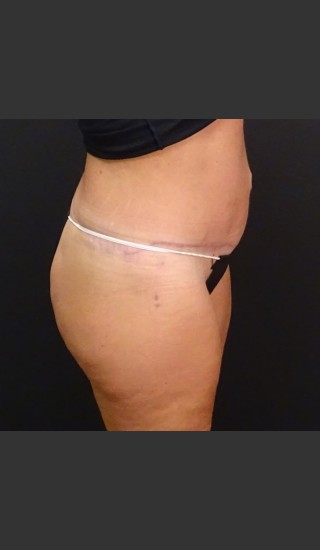 After Photo for Circumferential Body Lift Case #1 - Gallaher Plastic Surgery & Spa MD - Prejuvenation
