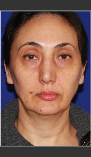 Before Photo for Facelift - Case 23 - Konstantin Vasyukevich, MD - Prejuvenation