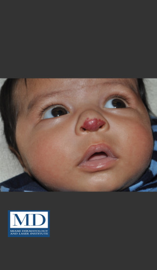 Before Photo for Port Wine Stain Treatment 105 - Jill S. Waibel, MD - Prejuvenation