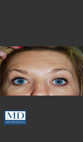 After Photo for Neurotoxin Treatment of Forehead 130 - Jill S. Waibel, MD - Prejuvenation