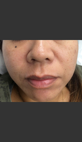 After Photo for IPL Photofacial  - Janell Ocampo - Prejuvenation