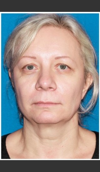 Before Photo for Facelift - Case 8 - Konstantin Vasyukevich, MD - Prejuvenation