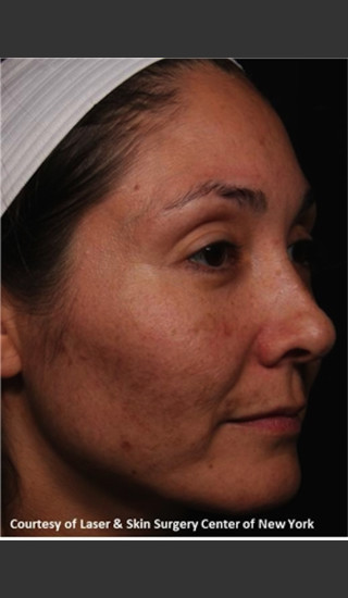 Before Photo for Full face Treament with Fraxel - Roy G. Geronemus, M.D. - Prejuvenation