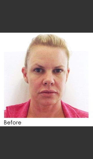Before Photo for Sculptra Facial Rejuvenation - Annie Chiu, MD - Prejuvenation