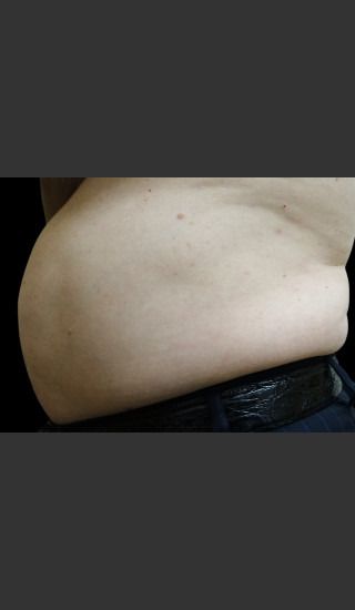 Before Photo for Body Contouring Treatment #116 -  - Prejuvenation