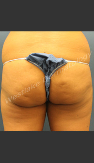 Before Photo for Fat Transfer to Buttocks - Kyle Coleman MD - Prejuvenation