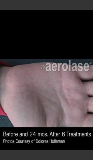 After Photo for Treatment of Psoriasis #335 -  - Prejuvenation