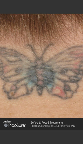 Before Photo for Tattoo Removal of Butterfly -  - Prejuvenation