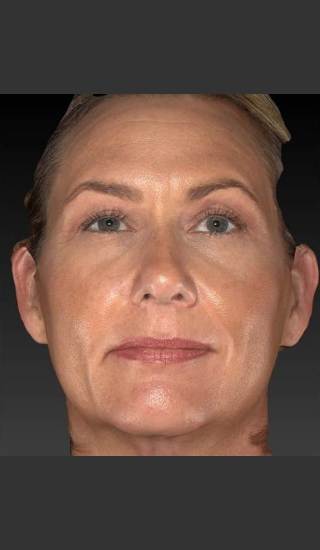 After Photo for Sun Damage Reduction - Douglas Wu, M.D. - Prejuvenation