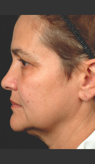 After Photo for Thermage Procedure Before and After II -  - Prejuvenation
