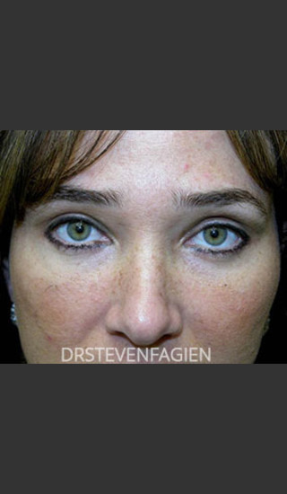 After Photo for Upper and Lower Blepharoplasty - Patient 6 - Steven Fagien, MD - Prejuvenation