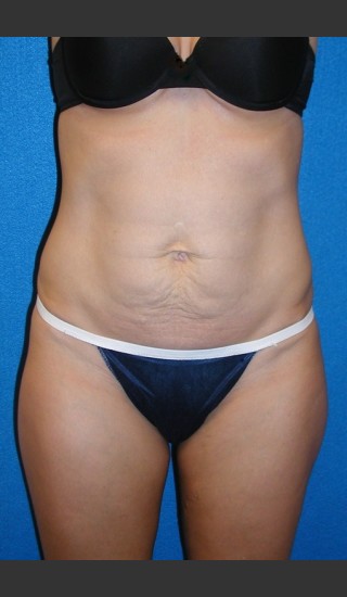 Before Photo for Tummy Tuck Case #2 - South Coast Plastic Surgery - Prejuvenation