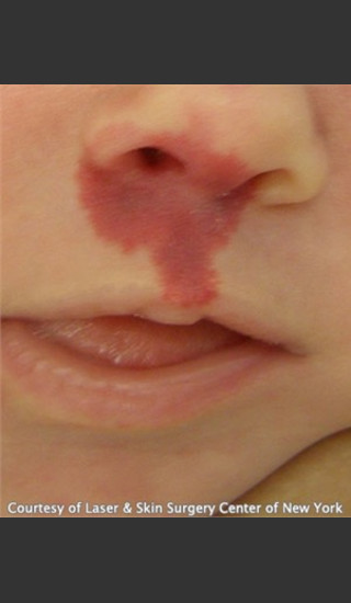 Before Photo for Treatment of Mouth Port Wine Stain  - Roy G. Geronemus, M.D. - Prejuvenation