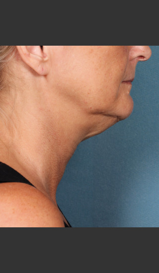 Before Photo for Kybella Treatment 55 Year Old Female -  - Prejuvenation